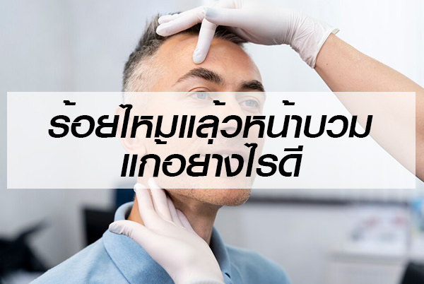 หลังร้อยไหม แล้วหน้าบวม วิธีแก้ไข