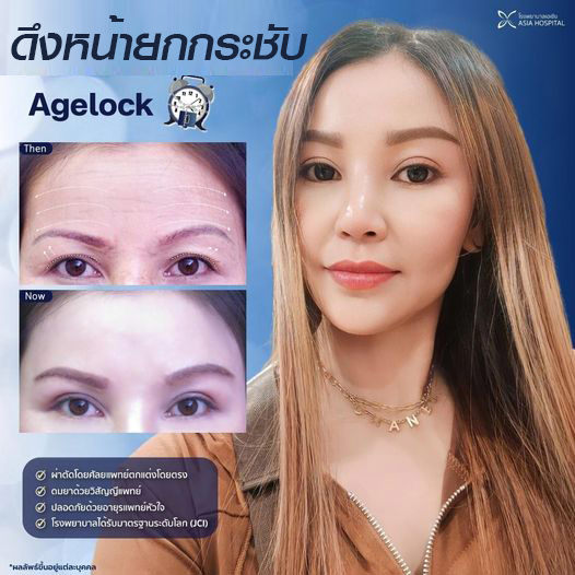 ผ่าตัดดึงหน้า Face Lift Surgery
